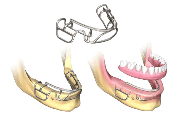 Customized Subperiosteal Dental Implants in Lynnwood