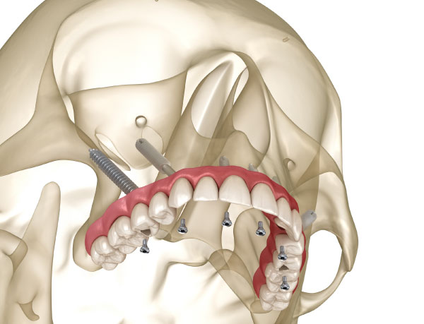 Pterygoid Dental Implants in Lynnwood, WA