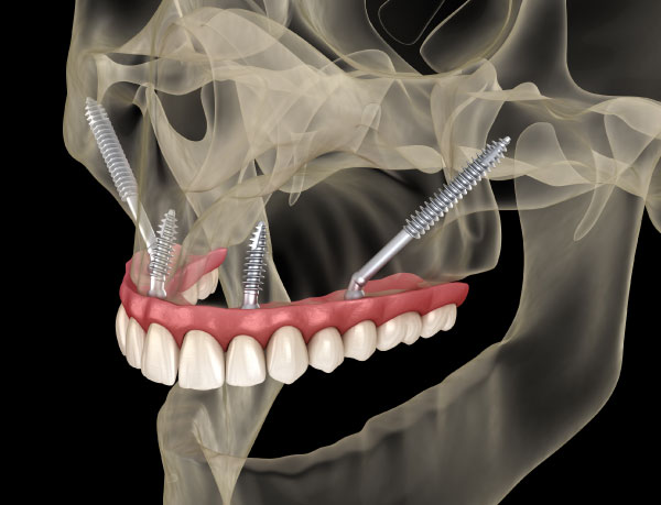 Zygomatic Dental Implants in Lynnwood, WA